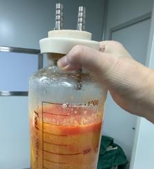晋江水动力吸脂手术要做多久？
